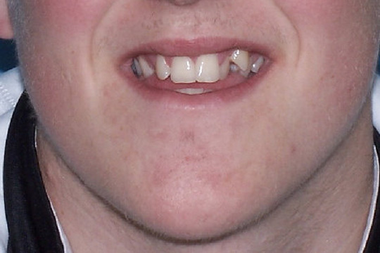 Blocked out teeth case study 1 - before