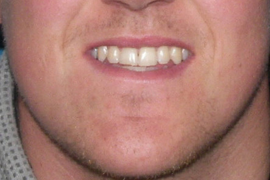 Blocked out teeth case study 1 - after