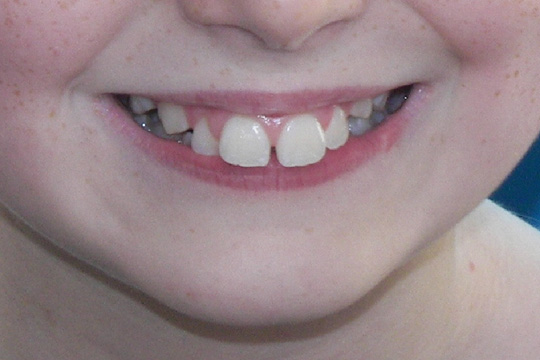 Prominent teeth case study 1 - before