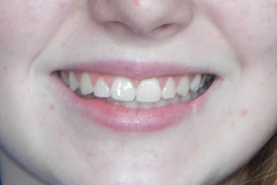 Prominent teeth case study 1 - after
