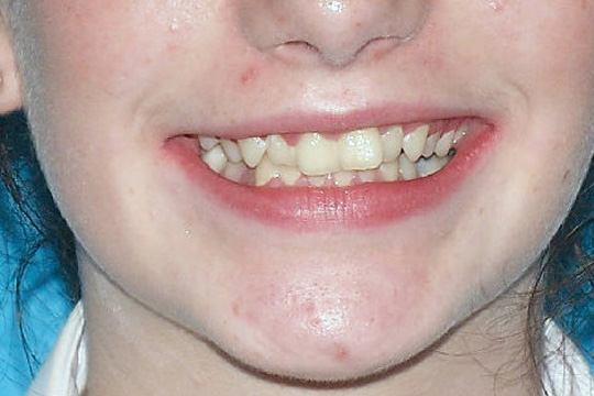 Crowded teeth case study 1 - before