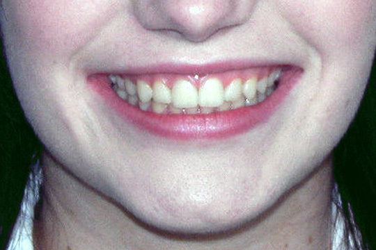 Crowded teeth case study 1 - after