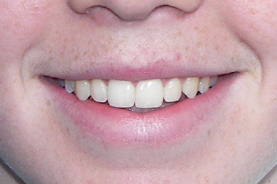 Pointed teeth case study 1 - after