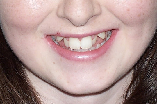 Pointed teeth case study 2 - before