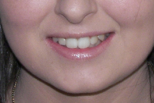 Pointed teeth case study 2 - after