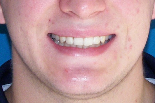 Crowded teeth case study 2 - after