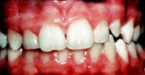 Mild orthodontic treatment