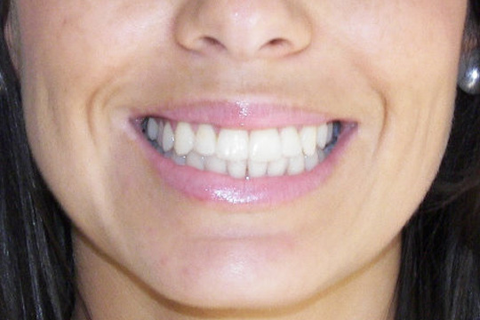 Blocked out teeth case study 2 - after