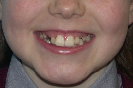 Prominent teeth case study 2 - before