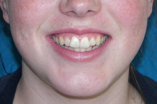 Prominent teeth case study 2 - after