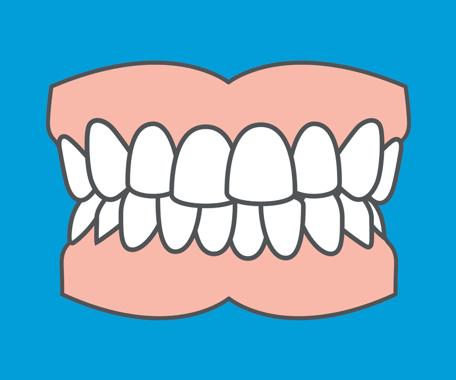 Common orthodontic problems - Crowding. Crowding can be corrected using removable or fixed braces, depending on how severe the problem is.