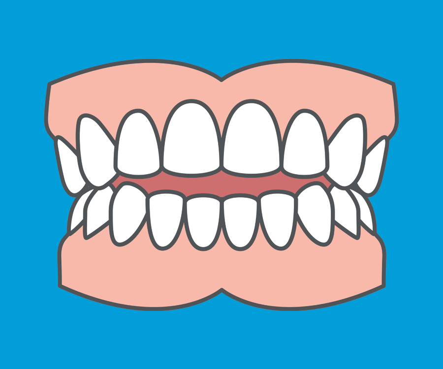 Common orthodontic problems - Open Bite. Most of the time, an open bite can be fixed using orthodontic treatment.