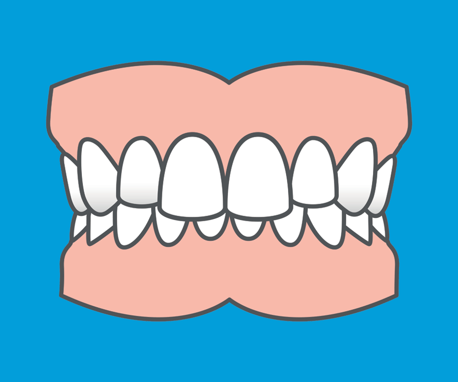 Common orthodontic problems - Overbite. Both fixed and removable braces can usually fix an overbite, depending how severe it is.