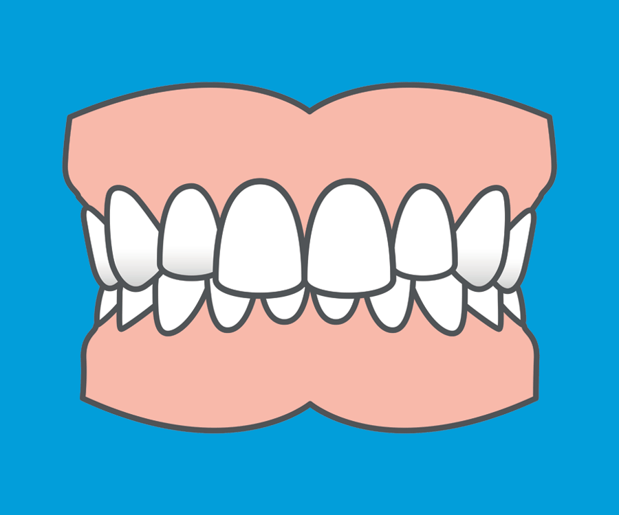 I have an overbite; what causes an overbite? - Orthodontic Society of  Ireland