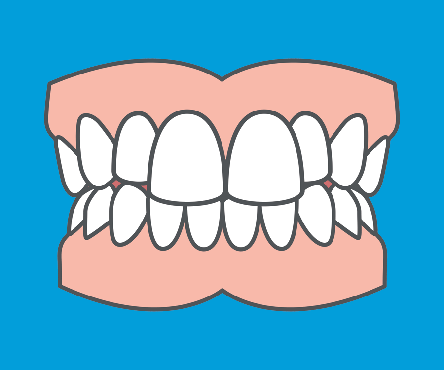 Common orthodontic problems - Prominent Teeth. The most common treatment for prominent teeth is fixed braces.