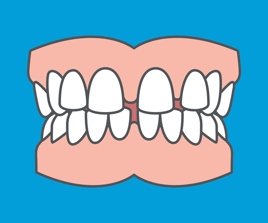 Common orthodontic problems - Spacing. Spacing between teeth is commonly treated using orthodontic treatment.
