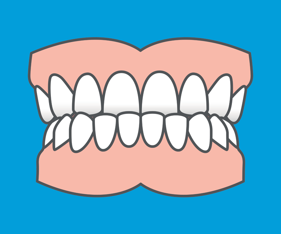 Common orthodontic problems - Underbite. Fixed and removable braces can usually fix an underbite but in some cases more complex treatment is involved.