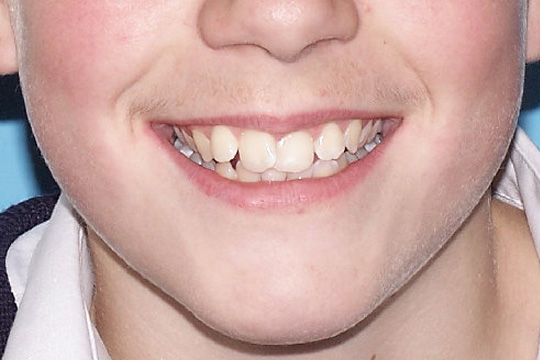 Curly teeth case study 2 - before