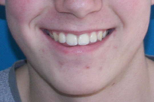 Curly teeth case study 2 - after