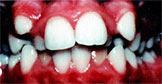 Complex orthodontic treatment