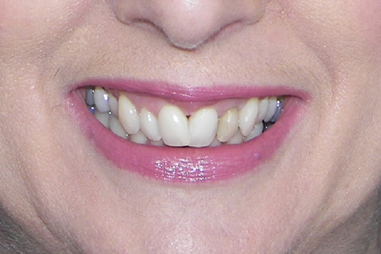 Curly teeth case study 1 - before