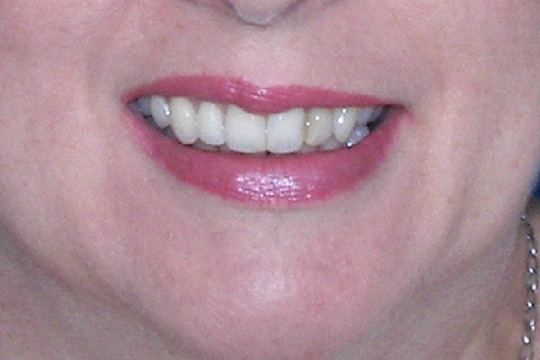 Curly teeth case study 1 - after