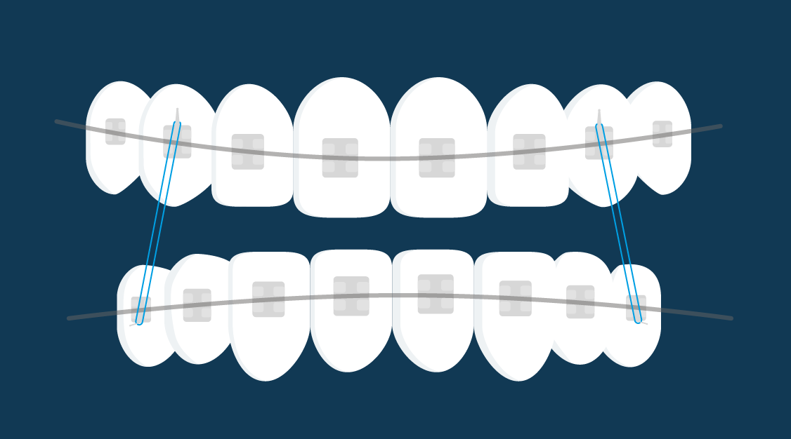 Types of braces | Ortho Dublin and Dundalk - Ceramic wBands Braces