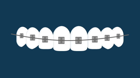 Types of braces | Ortho Dublin and Dundalk - Fixed Metal Braces