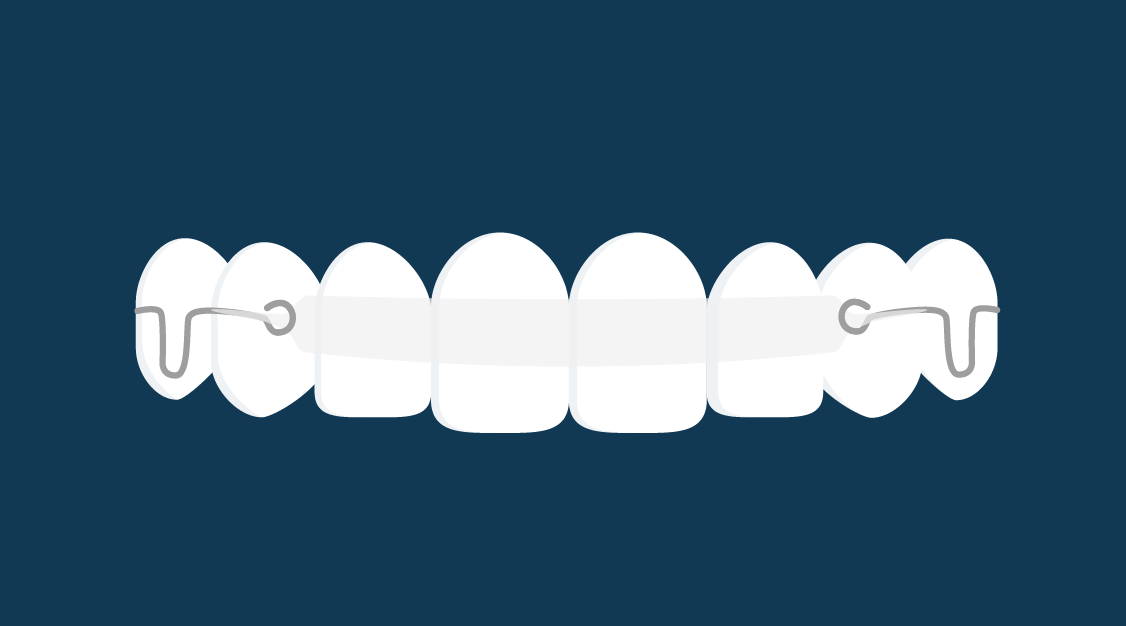 Types of braces | Ortho Dublin and Dundalk - Inman aligners