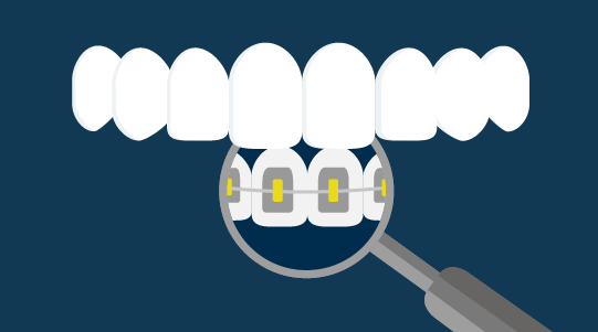 Types of braces | Ortho Dublin and Dundalk - Lingual or inside braces